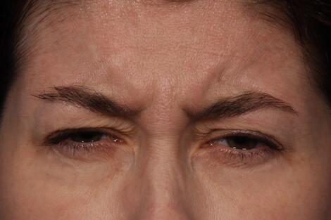 BOTOX® Cosmetic Gallery Before & After Image