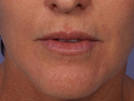Wrinkle Reduction Gallery Before & After Image