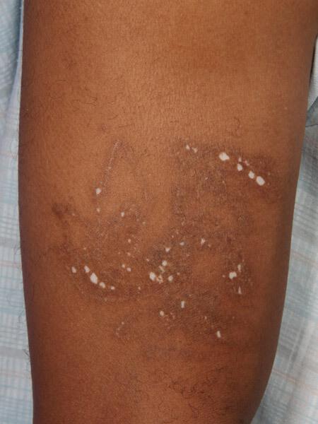 Scar Treatment Gallery Before & After Image